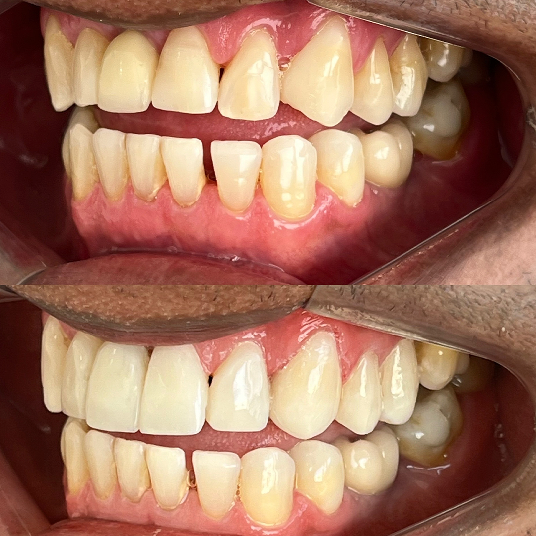 Antes e depois - Caso 1