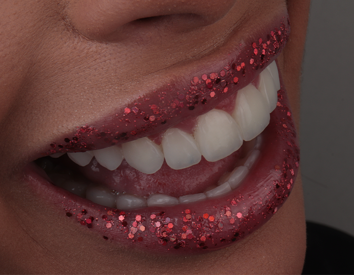 Facetas em Resina - Santa Cruz Odontologia