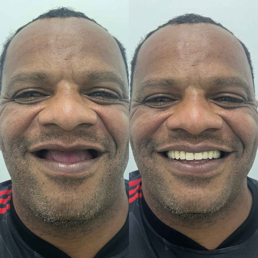 Implantes Dentários - Santa Cruz Odontologia