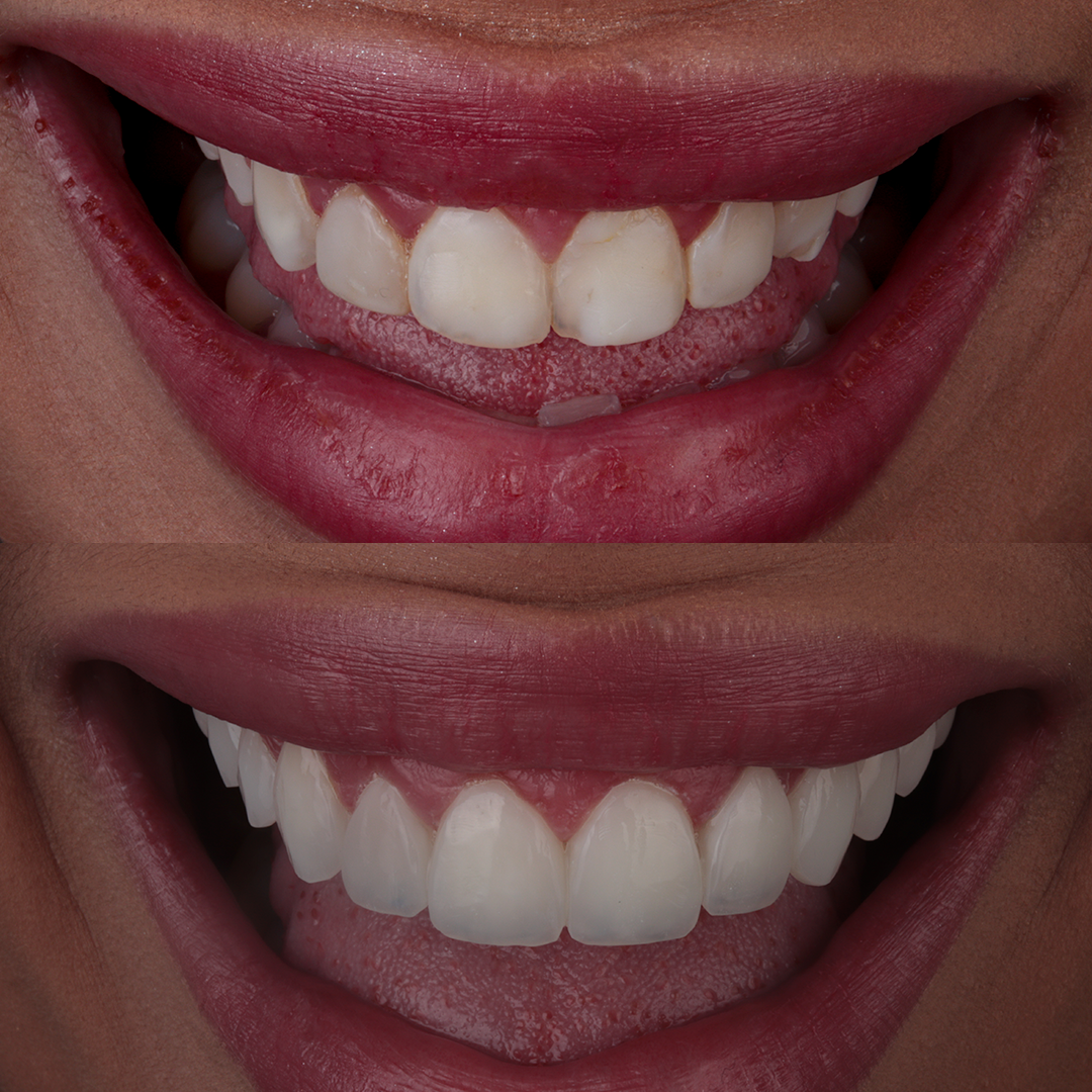 Facetas — caso 4