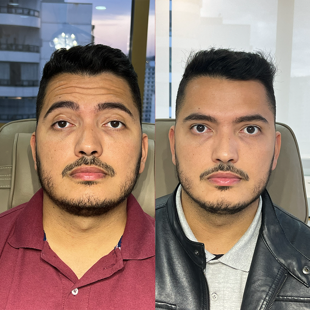 Harmonização Facial — caso real